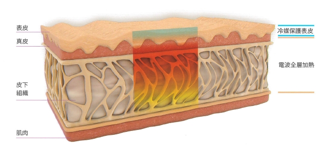 鳳凰電波是什麼？鳳凰電波加熱區域深入肌膚深層