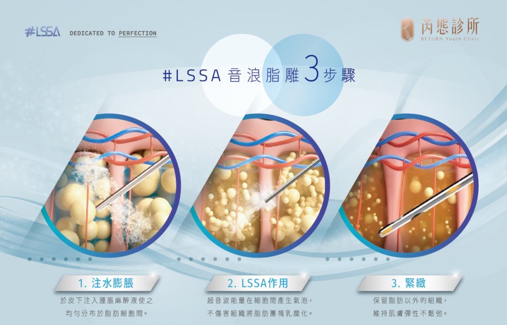 音浪脂雕 LSSA 3 步驟