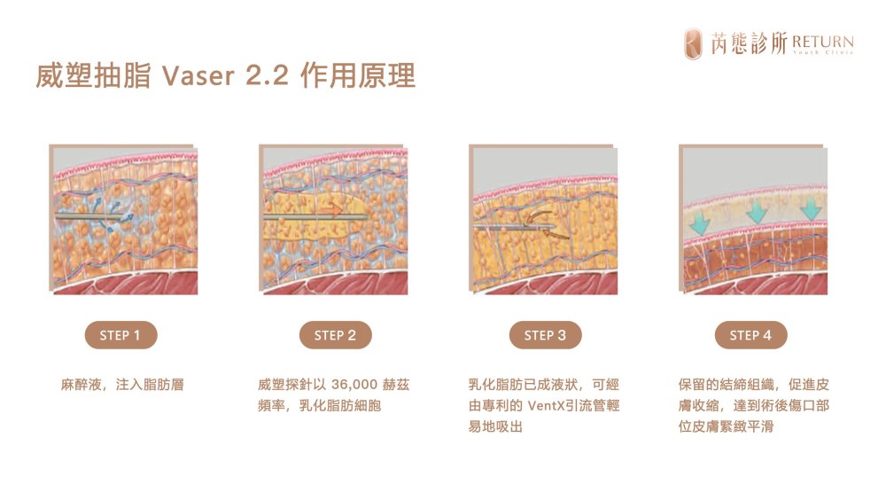 威塑抽脂 Vaser 2.2 步驟