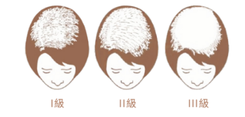 女性落髮型態 女性落髮型態
